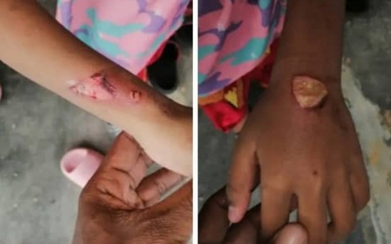 Cedera seluruh badan, kanak-kanak mangsa dera bapa, ibu tiri